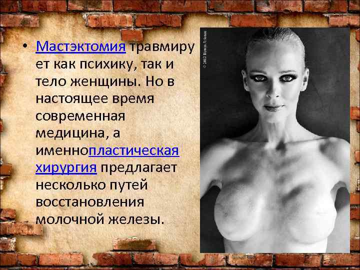  • Мастэктомия травмиру  ет как психику, так и  тело женщины. Но