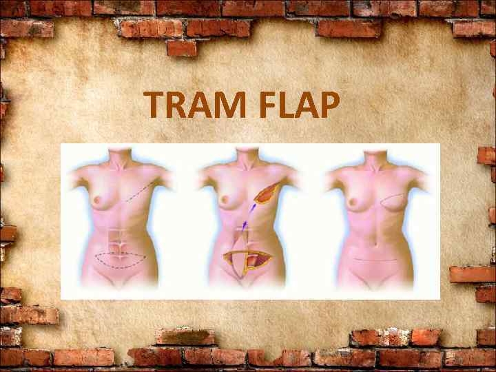 TRAM FLAP 
