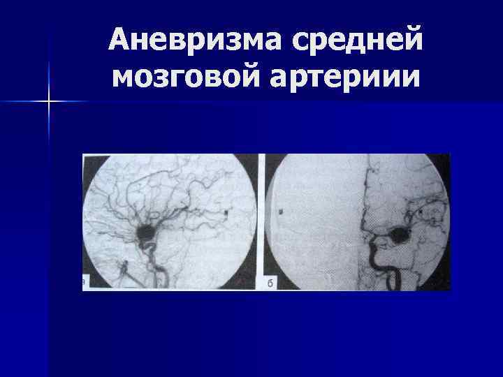 Аневризма средней мозговой артериии 