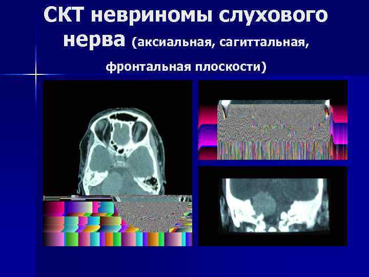 СКТ невриномы слухового нерва (аксиальная, сагиттальная,   фронтальная плоскости) 