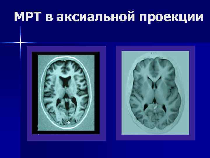 МРТ в аксиальной проекции 