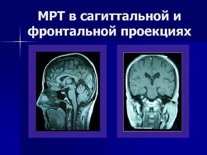  МРТ в сагиттальной и фронтальной проекциях 