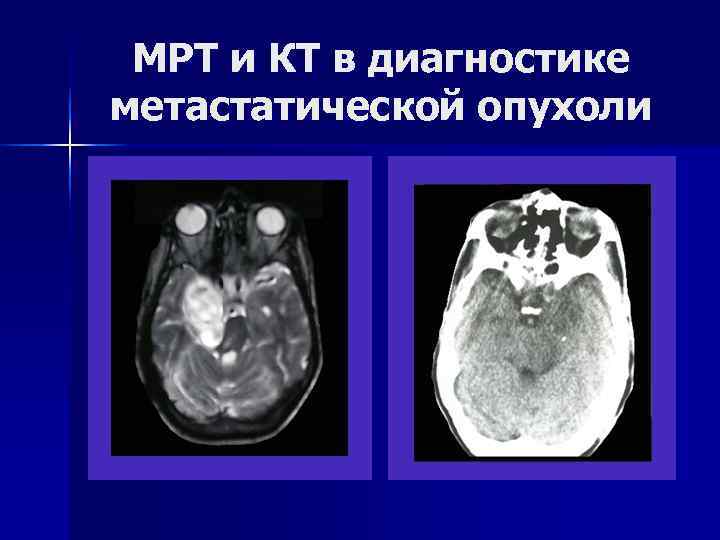  МРТ и КТ в диагностике метастатической опухоли 