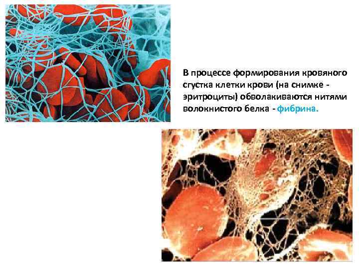 В процессе формирования кровяного сгустка клетки крови (на снимке - эритроциты) обволакиваются нитями волокнистого