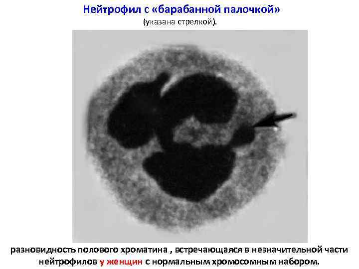     Нейтрофил с «барабанной палочкой»     (указана стрелкой).