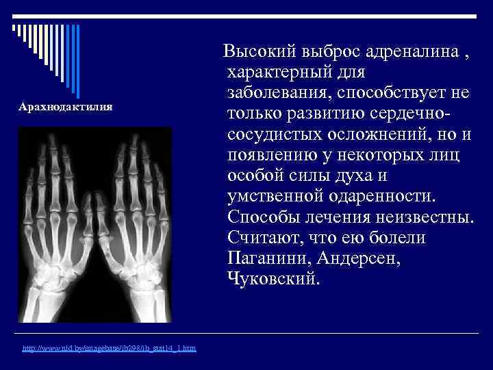      Высокий выброс адреналина ,     характерный