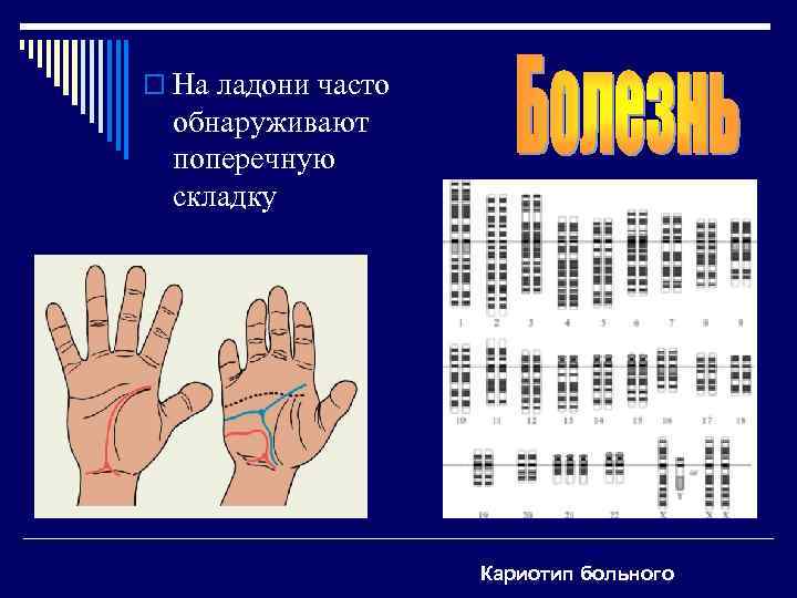 o На ладони часто  обнаруживают  поперечную  складку    