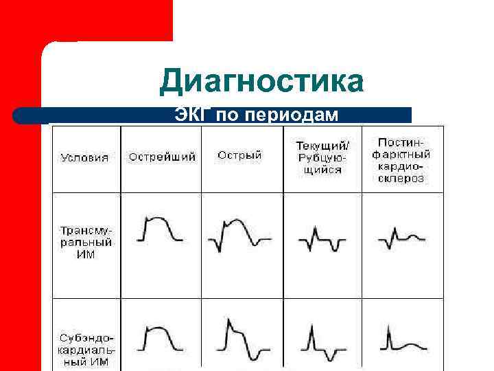Диагностика ЭКГ по периодам 