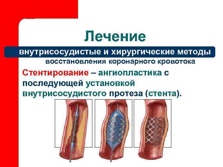    Лечение внутрисосудистые и хирургические методы восстановления коронарного кровотока Стентирование – ангиопластика