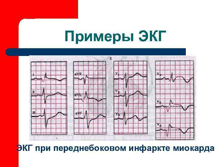    Примеры ЭКГ при переднебоковом инфаркте миокарда 