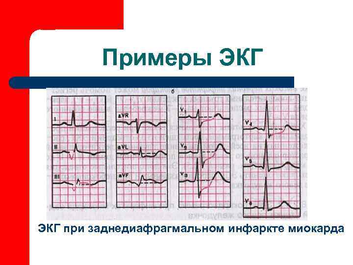    Примеры ЭКГ при заднедиафрагмальном инфаркте миокарда 