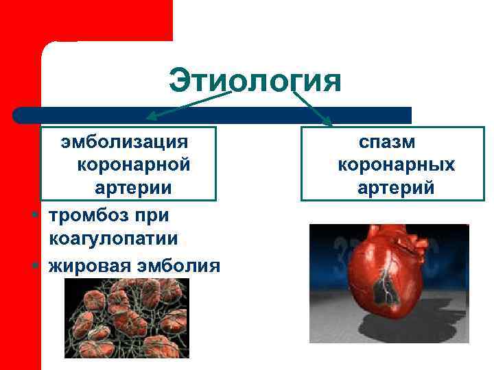   Этиология  эмболизация  спазм  коронарной коронарных   артерии 