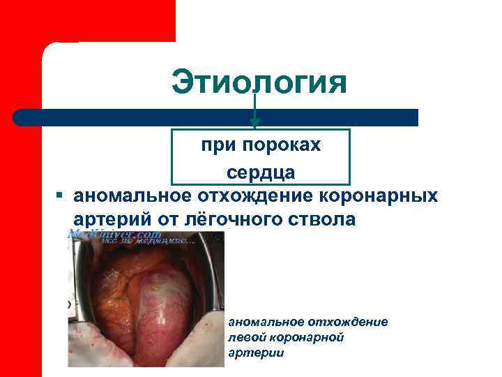    Этиология    при пороках   сердца § аномальное