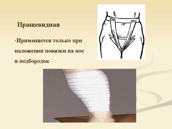 Пращевидная -Применяется только при наложении повязки на нос и подбородок 