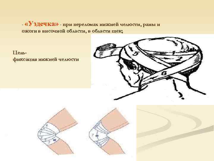   - «Уздечка» - при переломах нижней челюсти, раны и  ожоги в