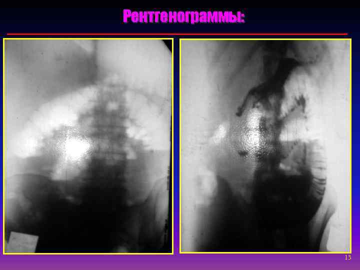 Рентгенограммы:    13 