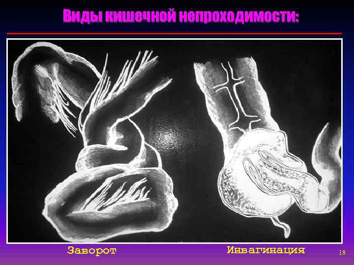 Виды кишечной непроходимости: Заворот   Инвагинация  18 