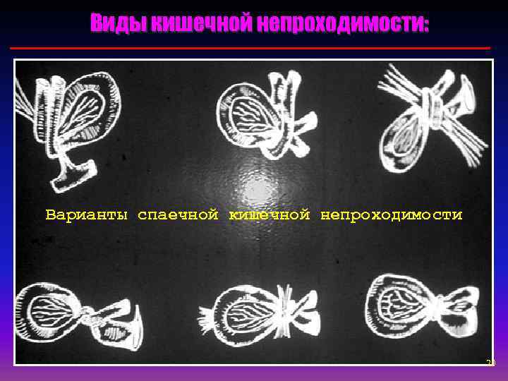   Виды кишечной непроходимости: Варианты спаечной кишечной непроходимости     20
