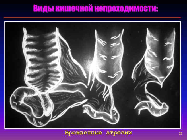 Виды кишечной непроходимости:   Врожденные атрезии  21 