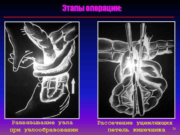    Этапы операции:  Развязывание узла  Рассечение ущемляющих при узлообразовании петель