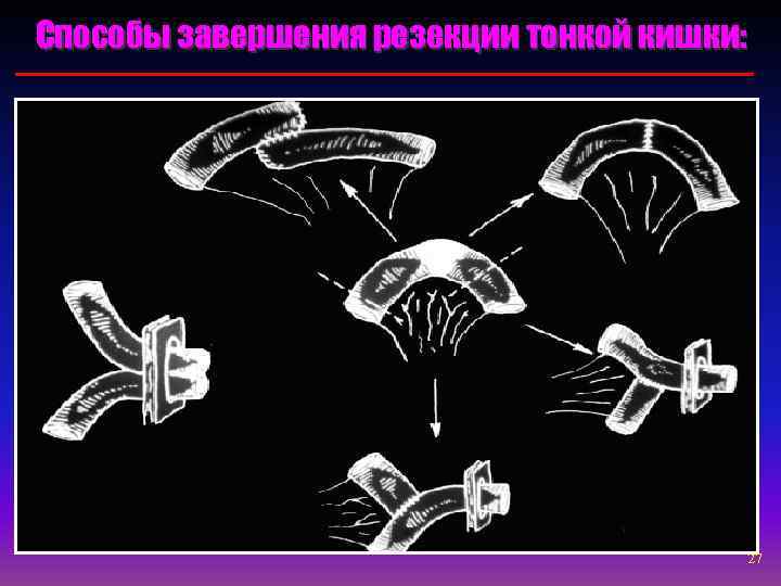 Способы завершения резекции тонкой кишки:     27 