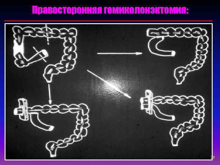 Правосторонняя гемиколонэктомия:       28 