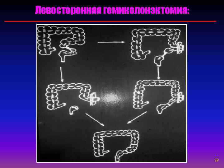 Левосторонняя гемиколонэктомия:    29 