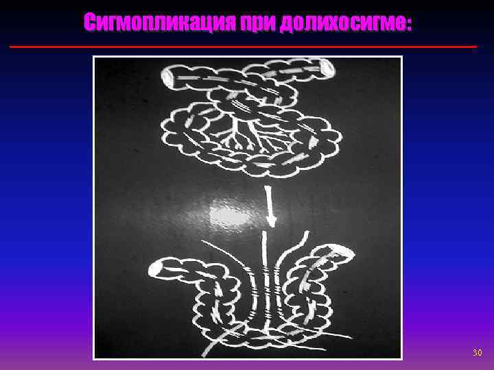 Сигмопликация при долихосигме:    30 