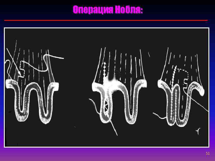 Операция Нобля:    31 