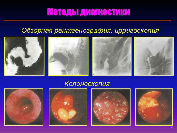 Методы диагностики Обзорная рентгенография, ирригоскопия Колоноскопия 11 