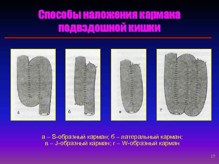 Способы наложения кармана подвздошной кишки а – S-образный карман; б – латеральный карман; в