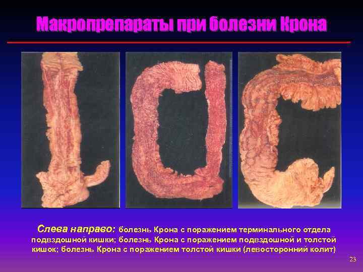 Макропрепараты при болезни Крона Слева направо: болезнь Крона с поражением терминального отдела подвздошной кишки;