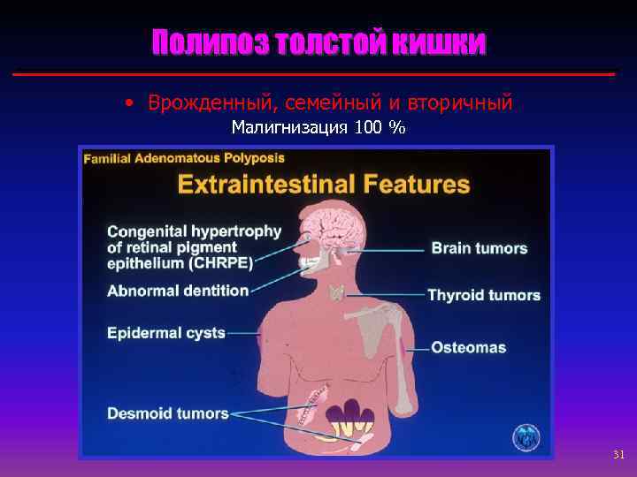 Полипоз толстой кишки • Врожденный, семейный и вторичный Малигнизация 100 % 31 