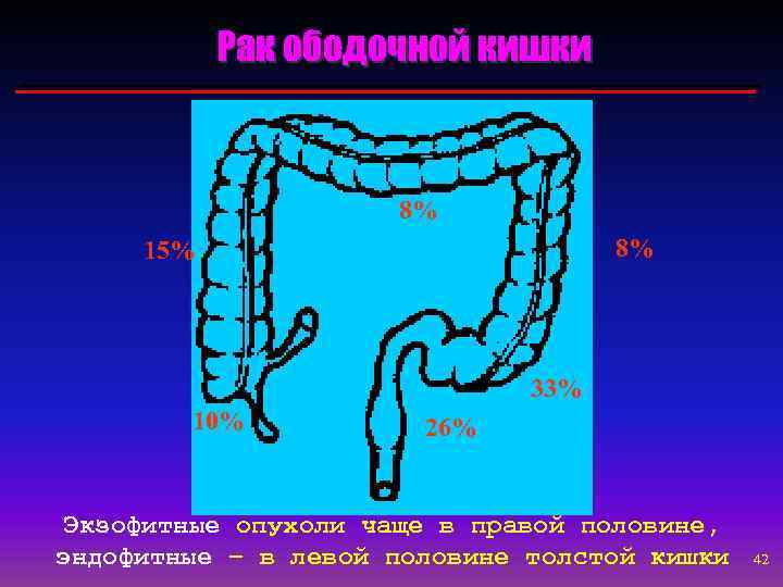 Рак ободочной кишки 8% 8% 15% 33% 10% 26% Экзофитные опухоли чаще в правой