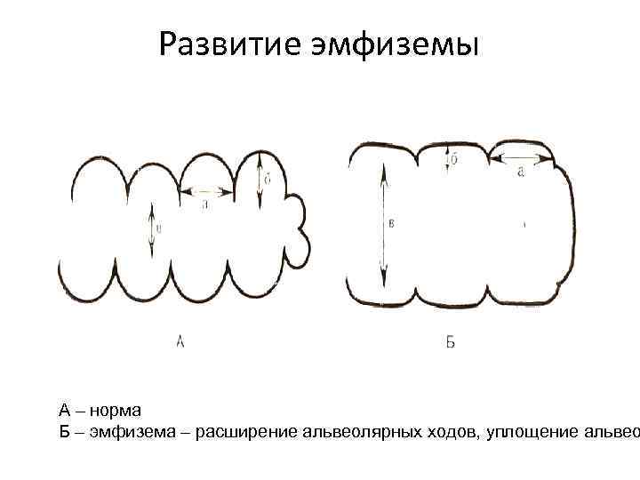    Развитие эмфиземы А – норма Б – эмфизема – расширение альвеолярных