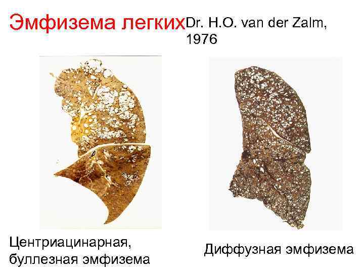 Эмфизема легких. Dr. H. O. van der Zalm,    1976 Центриацинарная, 