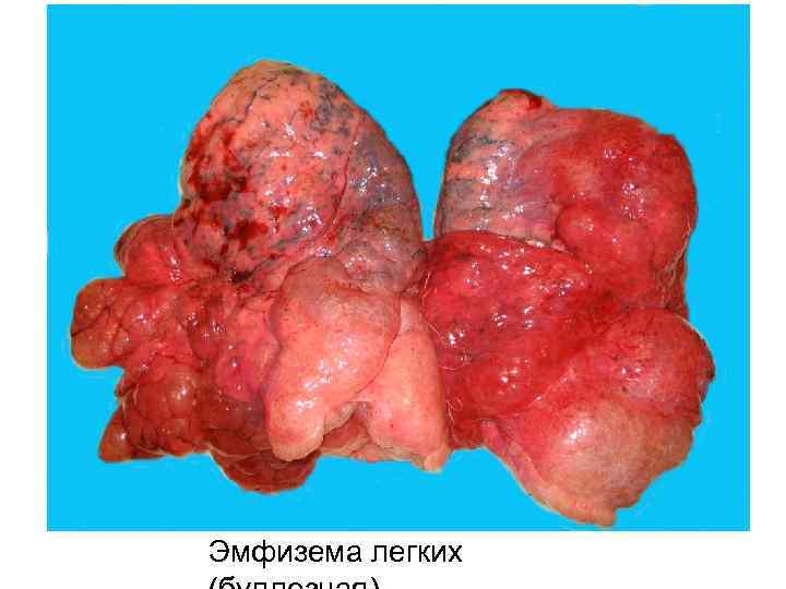 Эмфизема легких 