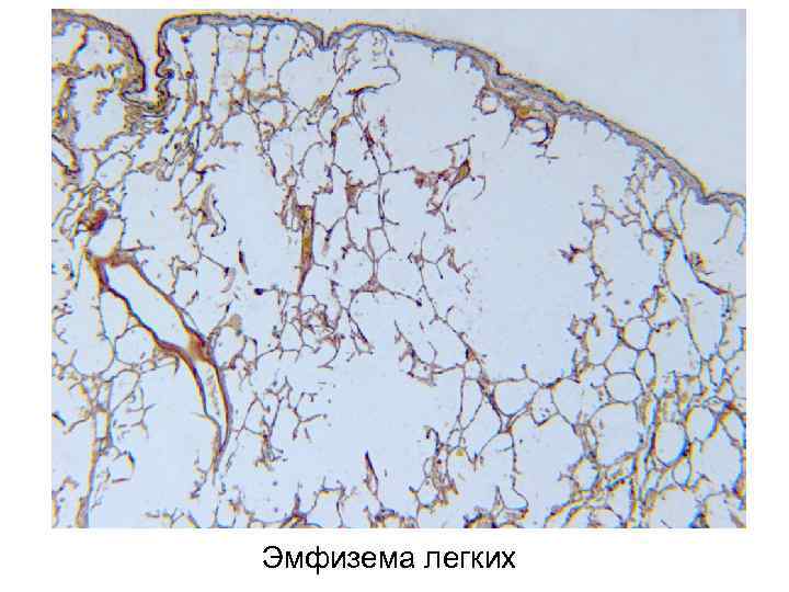 Эмфизема легких 