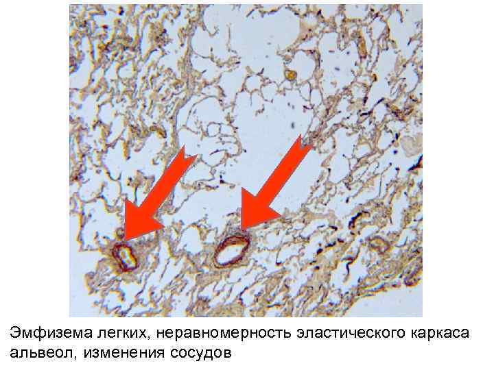 Эмфизема легких, неравномерность эластического каркаса альвеол, изменения сосудов 