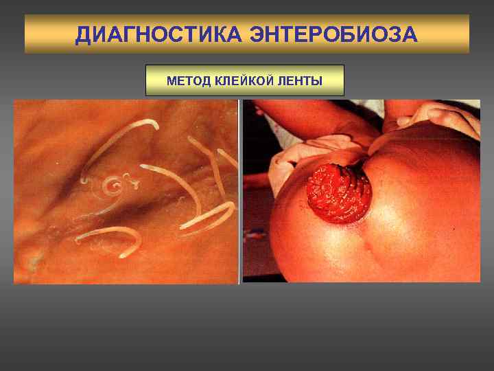 ДИАГНОСТИКА ЭНТЕРОБИОЗА  МЕТОД КЛЕЙКОЙ ЛЕНТЫ 