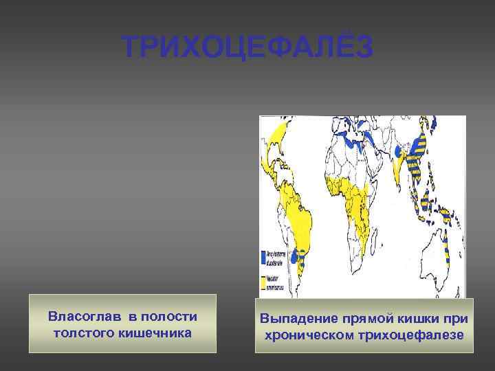    ТРИХОЦЕФАЛЁЗ Власоглав в полости  Выпадение прямой кишки при толстого кишечника