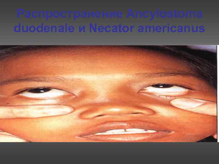 Распространение Ancylostoma duodenale и Necator americanus 