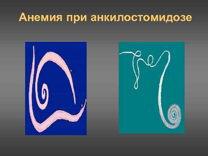 Анемия при анкилостомидозе 