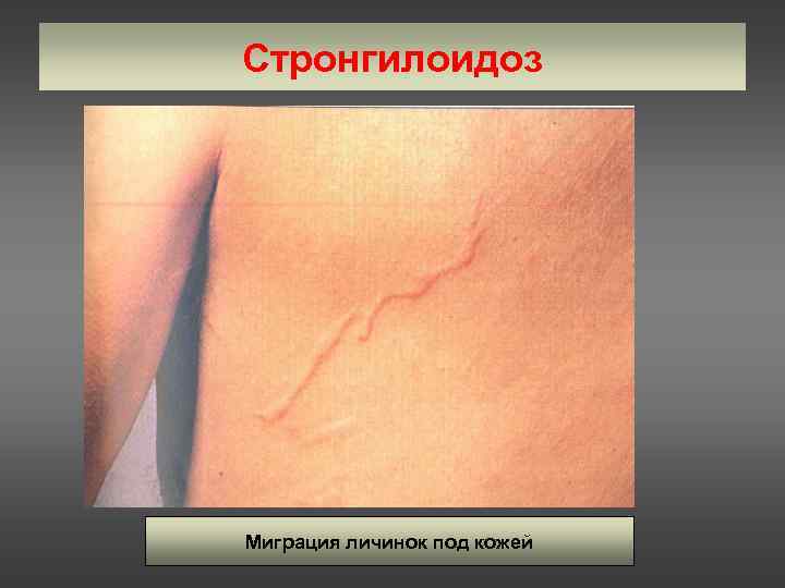 Стронгилоидоз Миграция личинок под кожей 