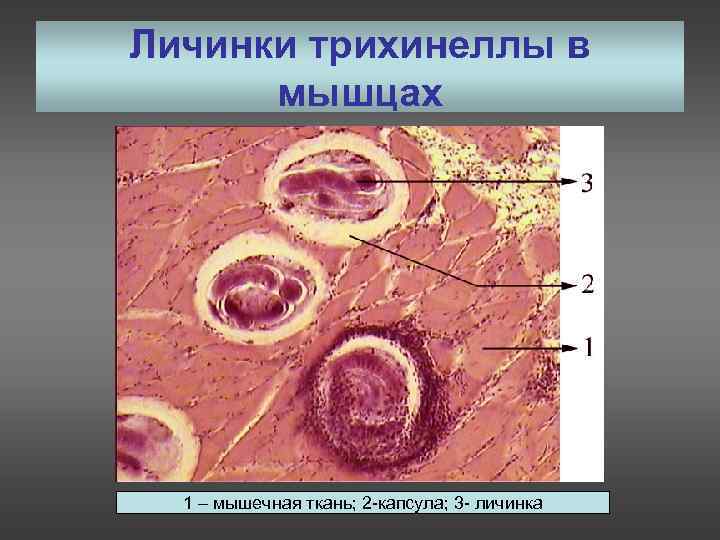 Личинки трихинеллы в  мышцах  1 – мышечная ткань; 2 -капсула; 3 -