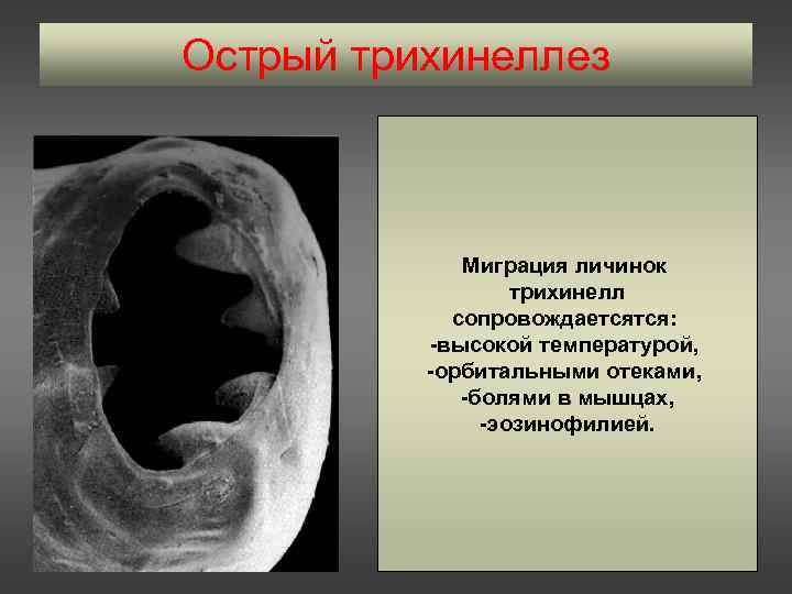 Острый трихинеллез   Миграция личинок    трихинелл   сопровождаетсятся: 