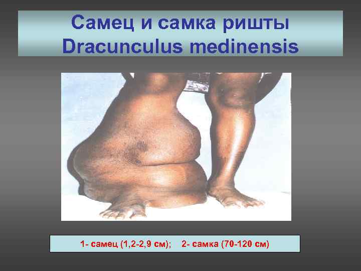  Самец и самка ришты Dracunculus medinensis 1 - самец (1, 2 -2, 9