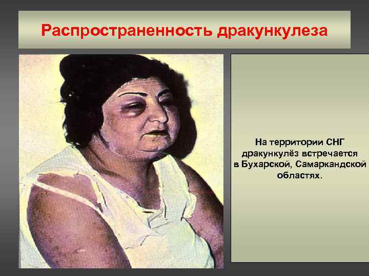 Распространенность дракункулеза     На территории СНГ    дракункулёз встречается