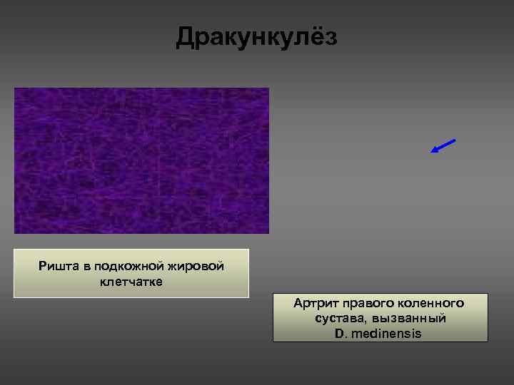    Дракункулёз Ришта в подкожной жировой   клетчатке   