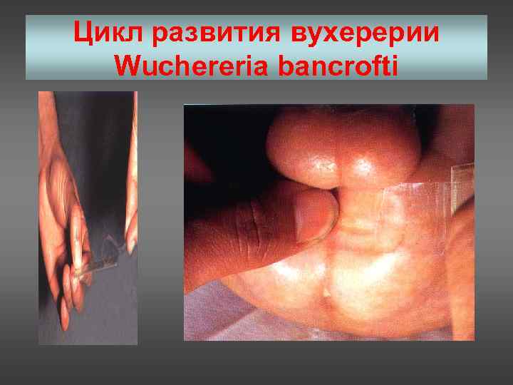 Цикл развития вухерерии  Wuchereria bancrofti 